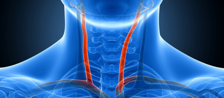 carotid invasive