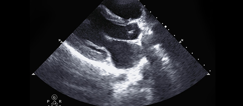 echocardiogramm